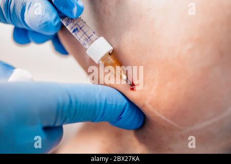 La correzione del contorno è una procedura per riempire le rughe e ripristinare il volume del tessuto - il medico effettua un'iniezione di acido ialuronico nella zona della mascella Foto Stock