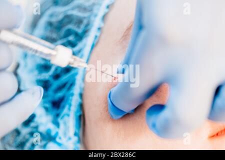 La procedura per l'introduzione del principio attivo - sotto la pelle, in zone pre-marcate, si fanno iniezioni di acido gualuronico - un ultrafine Foto Stock