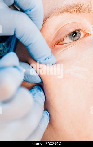 Formato immagine verticale - procedura per l'introduzione del principio attivo - sotto la pelle, in zone pre-marcate, iniezioni di aci gualuronico Foto Stock