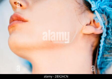 Mandibloplasty non chirurgico - gli angoli della mandibola - le iniezioni intradermali dolorose e sicure sono efficaci per correggere wri mimici e senili Foto Stock