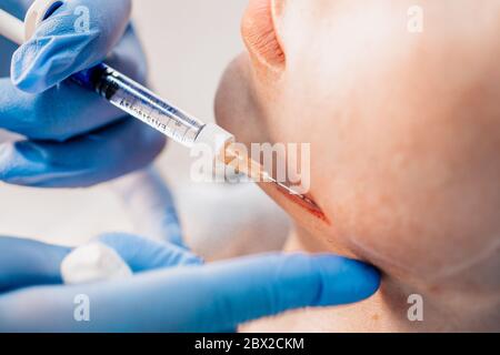 La procedura per l'introduzione del principio attivo - sotto la pelle, in zone pre-marcate, si fanno iniezioni di acido gualuronico - un ultrafine Foto Stock