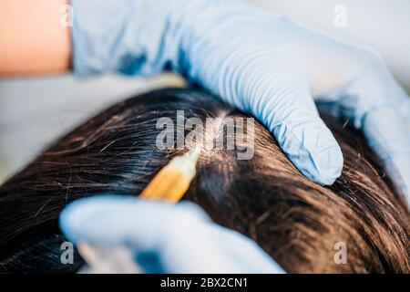 Il medico in guanti di gomma fa una procedura medica - inietta un'iniezione nel cuoio capelluto del paziente - il ripristino dei capelli Foto Stock