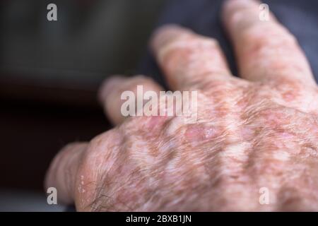 Lesioni di cheratosi attinica o macchie solari sulla pelle danneggiata dal sole della mano di un uomo. Questo può essere trattato con criochirurgia o con alcuni unguenti Foto Stock