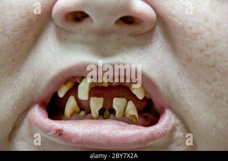 Decadimento dei denti Foto Stock