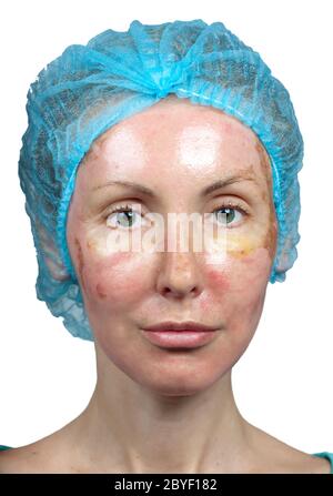 La cosmetologia. Nuova pelle dopo un peeling chimici, Foto Stock