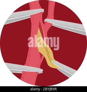 Illustrazione della chirurgia dell'arteria carotide Rimozione della placca con emostat Foto Stock