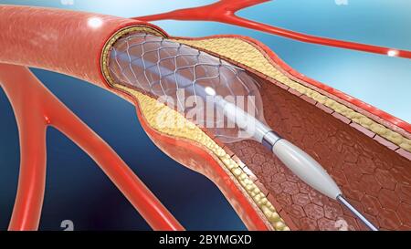 3d illustrazione di un impianto di stent per sostenere la circolazione del sangue nei vasi sanguigni Foto Stock