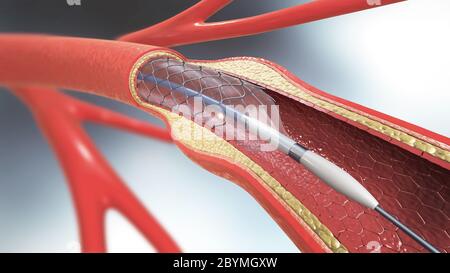 3d illustrazione di un impianto di stent per sostenere la circolazione del sangue nei vasi sanguigni Foto Stock