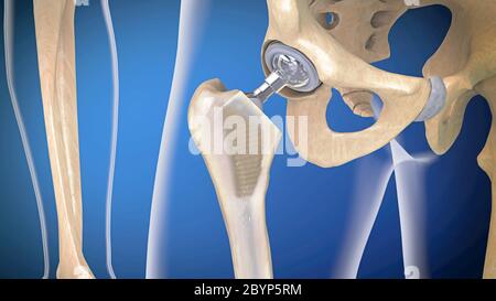 Funzione di un impianto articolare dell'anca o di una protesi dell'anca in vista frontale - illustrazione 3d Foto Stock