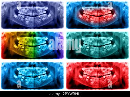 La radiografia panoramica è un radiografia dentale a scansione della mascella superiore e della mandibola inferiore. La foto mostra un bambino di 7 anni Foto Stock