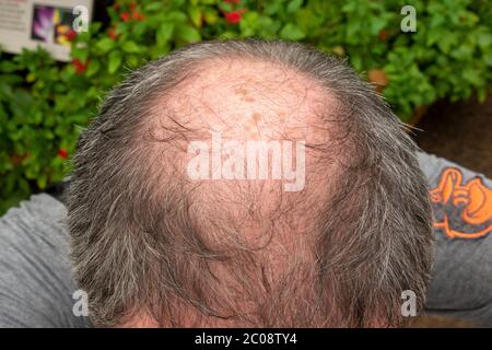 Primo piano della testa di un uomo parzialmente calvo (50 anni al momento della foto) in Inghilterra. Foto Stock