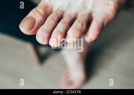 chiodi deboli sporchi e rotti sul piede maschio - danni e incrinature sui chiodi Foto Stock
