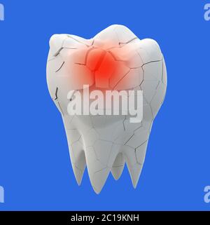 Dente di molari rotto e dente intero isolato su sfondo blu. illustrazione 3d Foto Stock