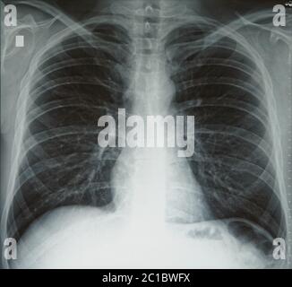 Radiografia toracica semplice, polmoni sani normali, bianco e nero Foto Stock