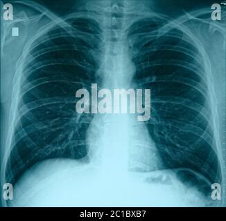 Radiografia toracica semplice, polmoni sani normali, tonica Foto Stock