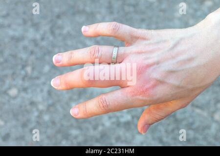 mano destra con un grande dito medio gonfio dopo un morso di ape con un anello di nozze, ingrandito in dimensioni a causa di reazione allergica dopo un pungiglione di vespa, rosso s Foto Stock