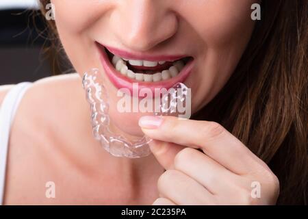 Close-up di una donna mettendo mano allineatore trasparente in denti Foto Stock