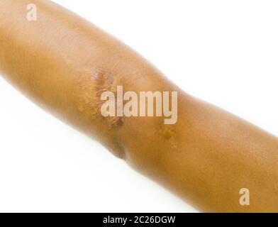 Closeup keloid cicatrice sul gomito della pelle asiatica dell'uomo dopo incidente motociclistico su sfondo bianco con spazio di copia. Foto Stock