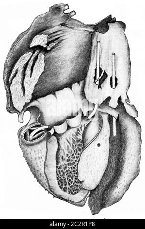 Cuore che mostra pericardite villosa, illustrazione vintage incisa. Foto Stock