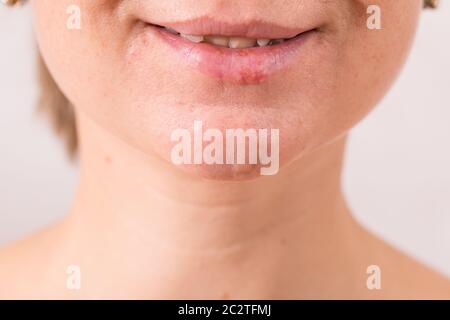 Primo piano delle labbra femminili che soffrono di herpe Foto Stock