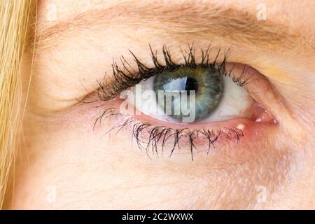 Stye, orzaiolo, infezione batterica dei womans occhio, mediche, farmaceutiche, occhio concetti Foto Stock