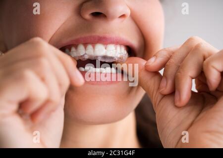 Cancellare la protezione notturna dentale dell'allineatore per i denti Foto  stock - Alamy