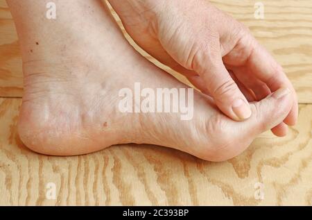 Pelle secca e cornea sulle dita dei piedi e sul tallone di una donna Foto Stock