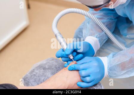 Trattamento di malattie fungine della pelle dei piedi e delle unghie. Foto Stock