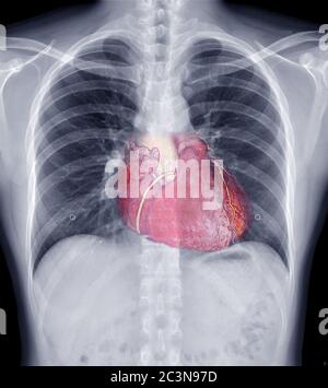 Mix radiografia toracica e 3D CTA immagine dell'arery coronarica che mostra il cuore all'interno del torace. Controllare il concetto. Foto Stock