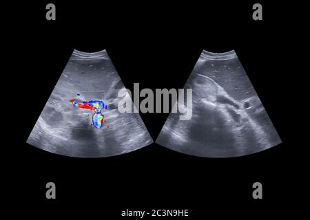 Ecografia dell'addome superiore che mostra l'anatomia del sistema epatobiliare e della vescica del fegato e della gallina per lo screening del carcinoma epatico delle cellule di hcc. Clipping Foto Stock