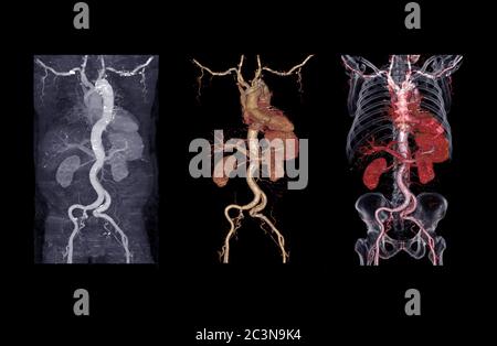 Raccolta di immagini di rendering 3D dell'aorta addominale CTA con dissezione aortica . Foto Stock