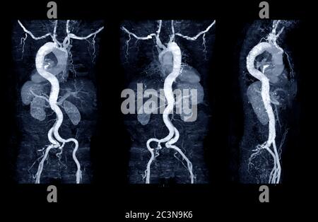 Raccolta dell'aorta CTA con tecnica MPR curva che mostra aorta addominale e arteria iliaca sinistra destra che mostra dissezione aortica . Foto Stock