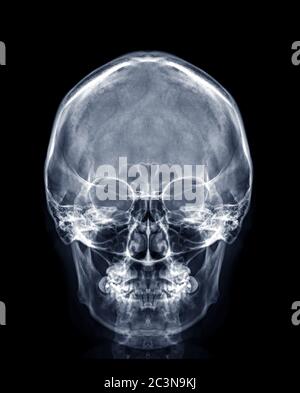 Immagine radiografica del cranio della vista AP del cranio umano o della vista frontale isolata su sfondo nero. Foto Stock