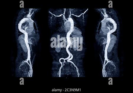 Raccolta dell'aorta CTA con tecnica MPR curva che mostra aorta addominale e arteria iliaca sinistra destra che mostra dissezione aortica . Foto Stock