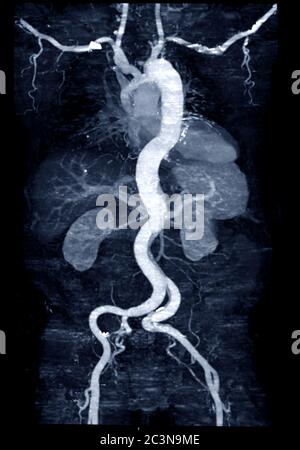 CTA con tecnica MPR curva che mostra aorta addominale e arteria iliaca sinistra destra che mostra dissezione aortica . Foto Stock