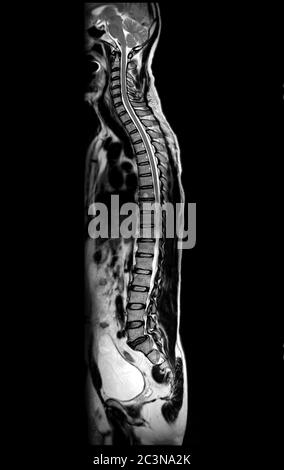 MRI del piano sagittale T2W della colonna intera per la compressione diagnostica del midollo spinale. Foto Stock