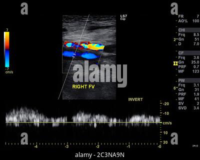 Un'immagine a ultrasuoni Doppler è un test non invasivo che può essere utilizzato per stimare il flusso sanguigno attraverso i vasi sanguigni facendo rimbalzare sou ad alta frequenza Foto Stock