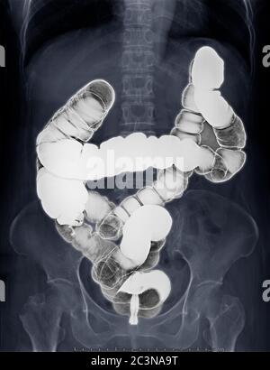Fuoco selettivo dell'immagine di enema di bario o immagine di raggi X di intestino grande che brilla sull'addome mostrando anatomico del colon per rilevare il cancro del colon . Foto Stock
