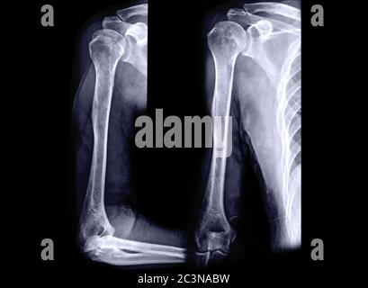 Immagine radiografica dell'osso omero AP e vista laterale . Foto Stock