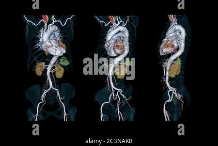 Immagine di rendering 3D dell'aorta intera CTA su sfondo nero per rilevare l'aneurisma aortico. Foto Stock