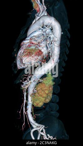 Immagine di rendering 3D CTA intera aorta vista laterale su sfondo nero per rilevare aneurisma aortico. Foto Stock