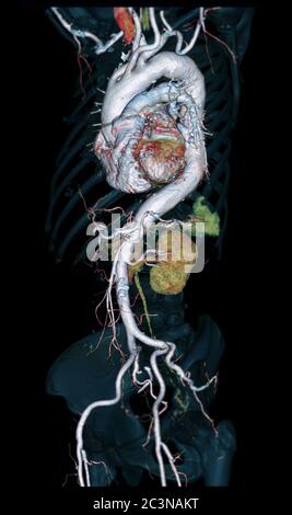 Immagine di rendering 3D dell'aorta intera CTA vista obliqua su sfondo nero per rilevare l'aneurisma aortico. Foto Stock
