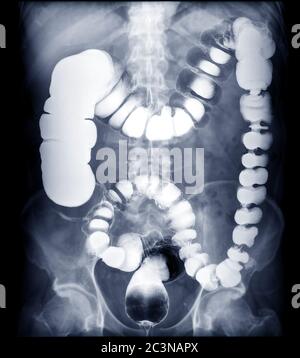 IMMAGINE DI enema DI BARIO O di ESSERE o immagine di raggi X di intestino grande che mostra anatomico del colon per rilevare il cancro di colon . Foto Stock
