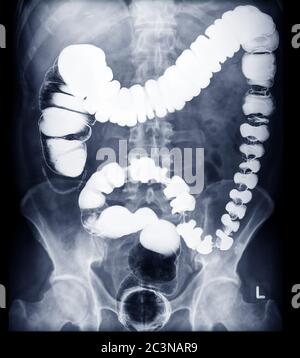 IMMAGINE DI enema DI BARIO O DI RAGGI X DELLA vista del colon prono che mostra l'anatomia del colon per rilevare il cancro del colon . Foto Stock