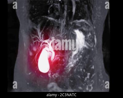 Risonanza magnetica colangiopancreatina o immagine MRCP 3D MIP che mostra la visualizzazione dei dotti biliari e pancreatici. . Foto Stock