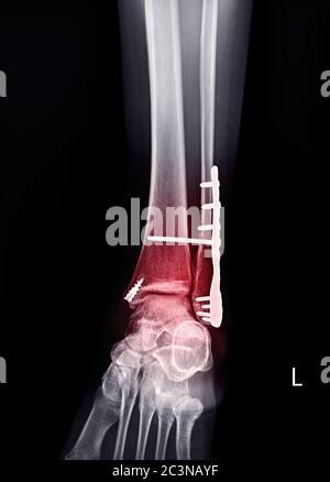 Immagine radiografica della caviglia o dell'immagine radiografica o radiografica dell'articolazione sinistra della caviglia Vista AP che mostra un intervento chirurgico su piastra della caviglia e viti con osso della fibola da frattura. Foto Stock