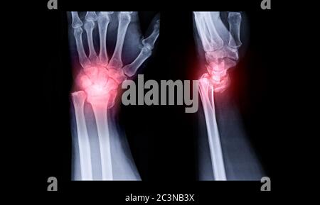 Immagine radiografica dell'articolazione del polso sinistro AP e vista laterale per la visualizzazione della frattura dell'osso radiale. Foto Stock