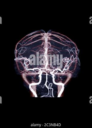 Immagine di fusione e MRA e MRV brainshowign circolazione del flusso sanguigno se il cervello. Foto Stock