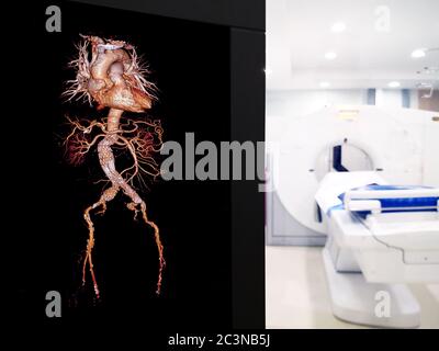 Immagine di rendering 3D dell'aorta addominale CTA con innesto a stent su scheletro trasparente sullo schermo nella sala dello scanner TC. Foto Stock