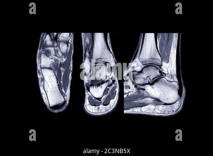 Confrontare la vista assiale, coronale e sagittale del giunto caviglia RM per la visualizzazione t2 per la diagnosi di lesioni da tendini. Foto Stock